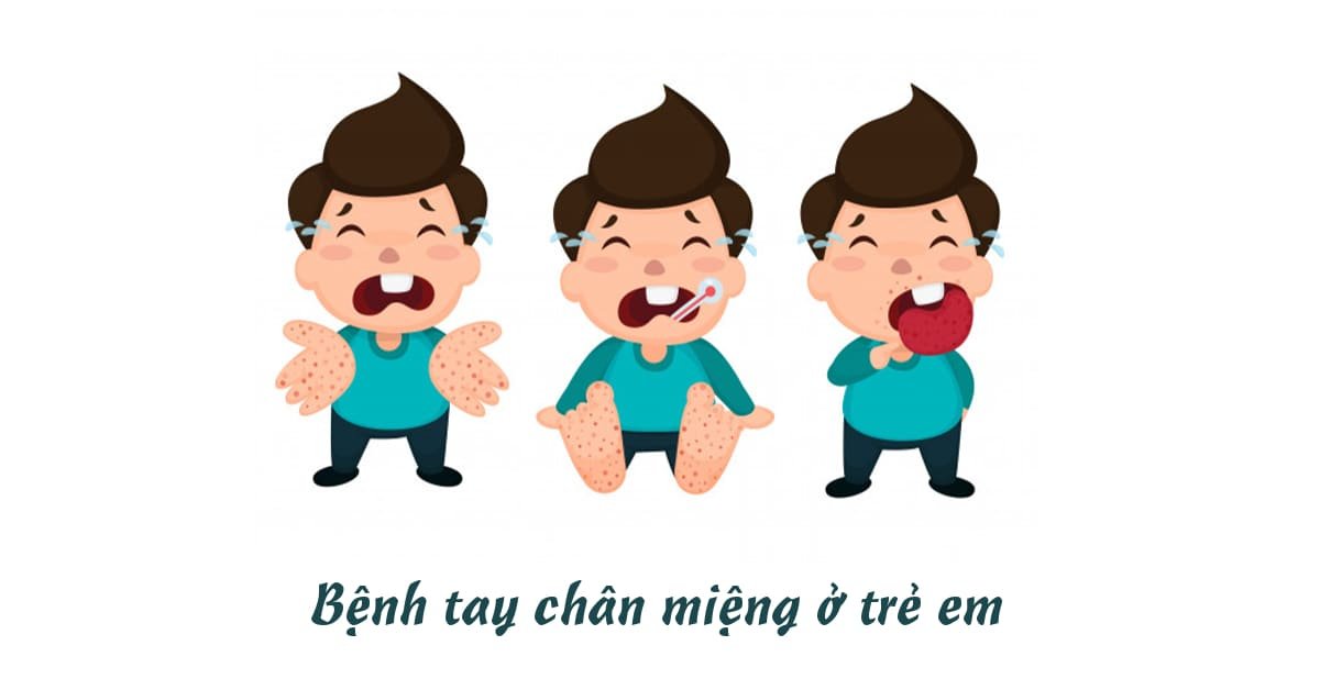 tay chân miệng